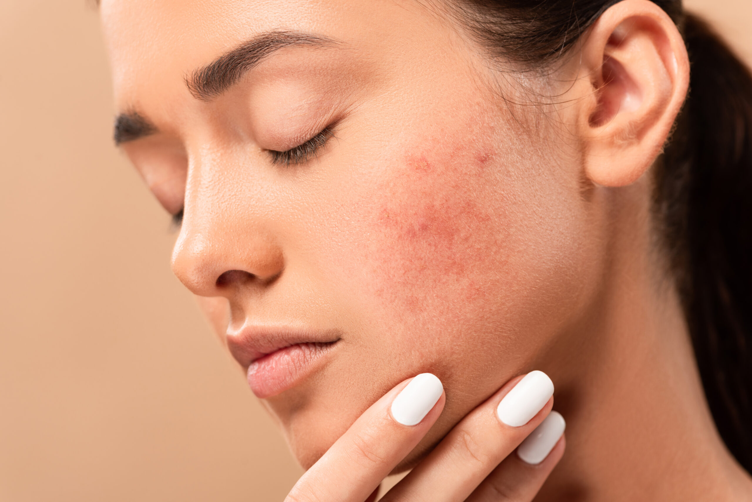 young woman with closed eyes touching face with acne isolated on - Swan Dermatology | Dermatology About Flexile Classic