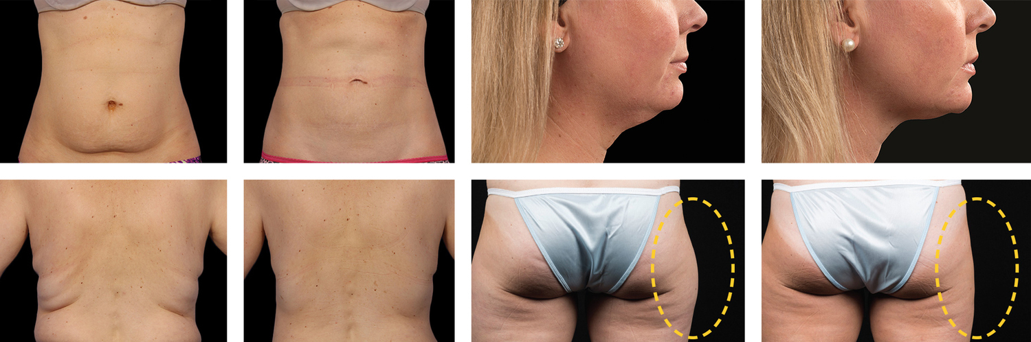 coolsculpting-examples - Swan Dermatology | Dermatology