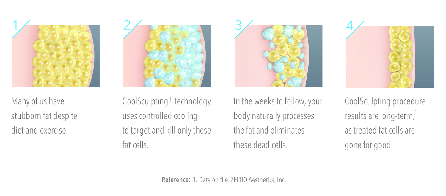 coolsculpting-steps - Swan Dermatology | Dermatology